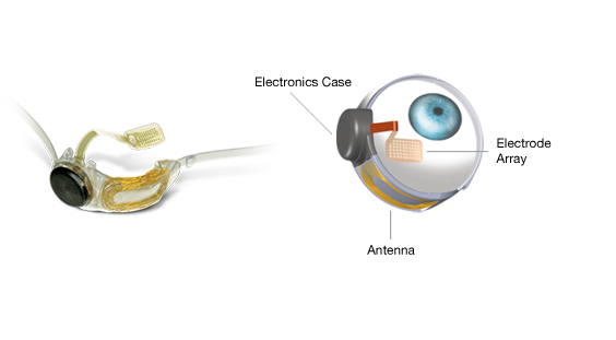 Detalle del dispositivo que se implanta quirurjicamente