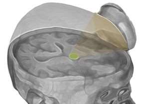 Despiertan el cerebro de una persona en coma con ultrasonidos