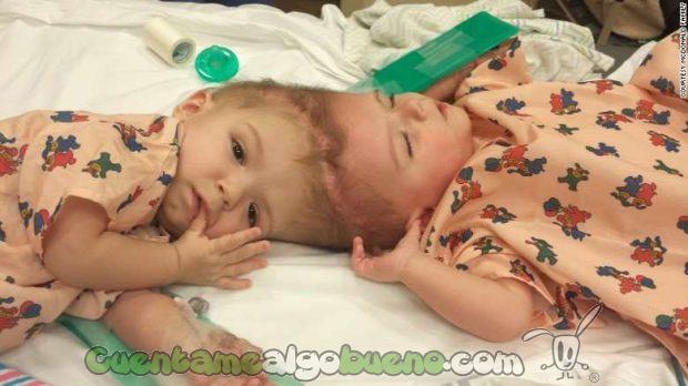 20161017-2-separan-gemelos-siameses-unidos-por-la-cabeza-01