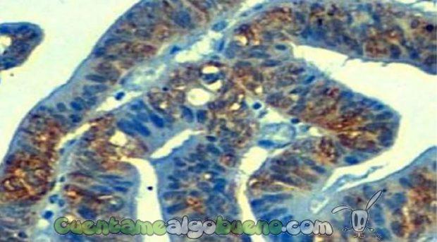 Sección de un cáncer de estómago vista al microscopio mostrando expresión aberrante de la proteina YBX1 (teñida de color marrón). Foto: sinc.