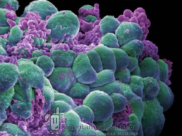 Células de cáncer de pecho. El estudio llevado a cabo podría eliminarlas con nanopartículas magnéticas. Foto: crafty_dame.
