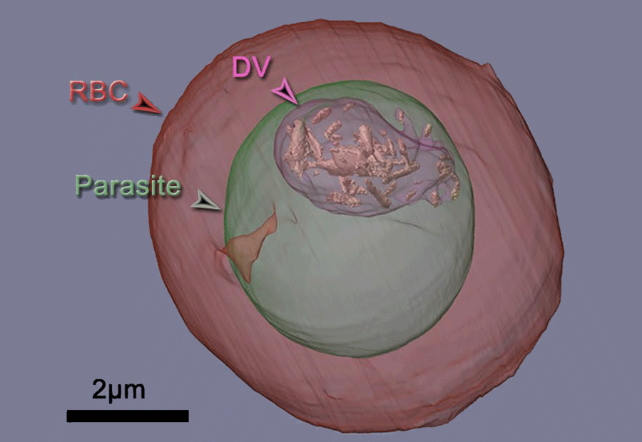 Tomografía donde se ve el parásito (marcado en verde) dentro del glóbulo rojo (RBC marcado en rojo). En el parásito se observa la vacuola digestiva (DV) donde se concentran los cristales de hemozoína formados. Foto: Sincrotrón ALBA.