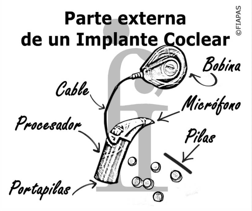 Diagrama mostrando los componentes de la parte externa de un implante coclear, cortesía de FIAPAS