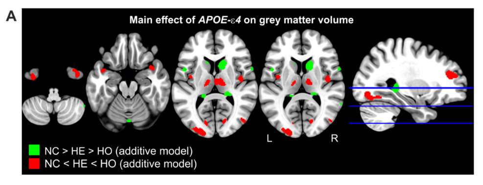 En el estudio, los investigadores del BBRC han detectado alteraciones morfológicas cerebrales en personas cognitivamente sanas portadoras del gen que confiere el mayor riesgo genético de desarrollar la enfermedad de alzheimer, el APOE-Ɛ4