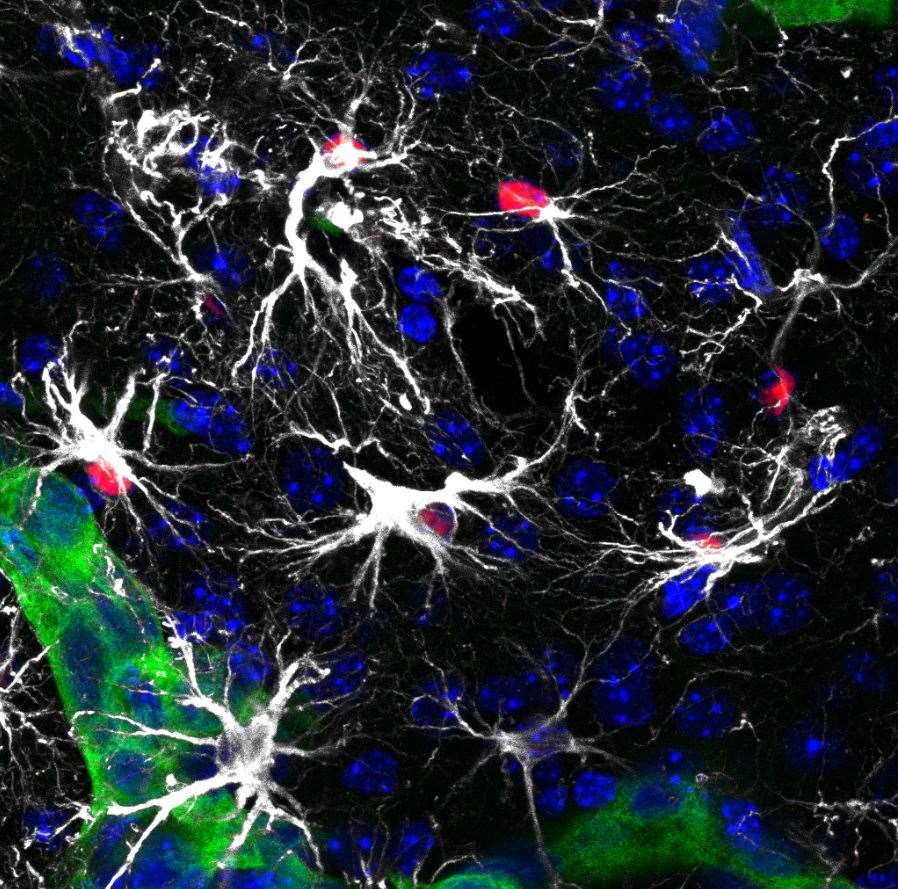 La silibinina es una sustancia natural que se encuentra en el cardo mariano, es la clave de esta nueva terapia para reducir la metástasis cerebralLa imagen muestra células metastáticas en el cerebro (en verde) rodeadas por astrocitos reactivos (en blanco). Algunos de ellos tienen la vía de STAT3 activada (núcleo en rojo). Los astrocitos reactivos con STAT3 activo ayudan a las células tumorales a crecer y desarrollarse en el cerebro modificando la inmunidad local. Foto: CNIO