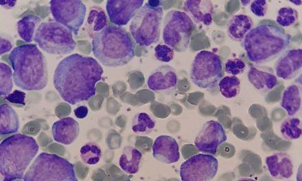 OneChain Immunotherapeutics (OCI) nace para luchar contra la leucemia