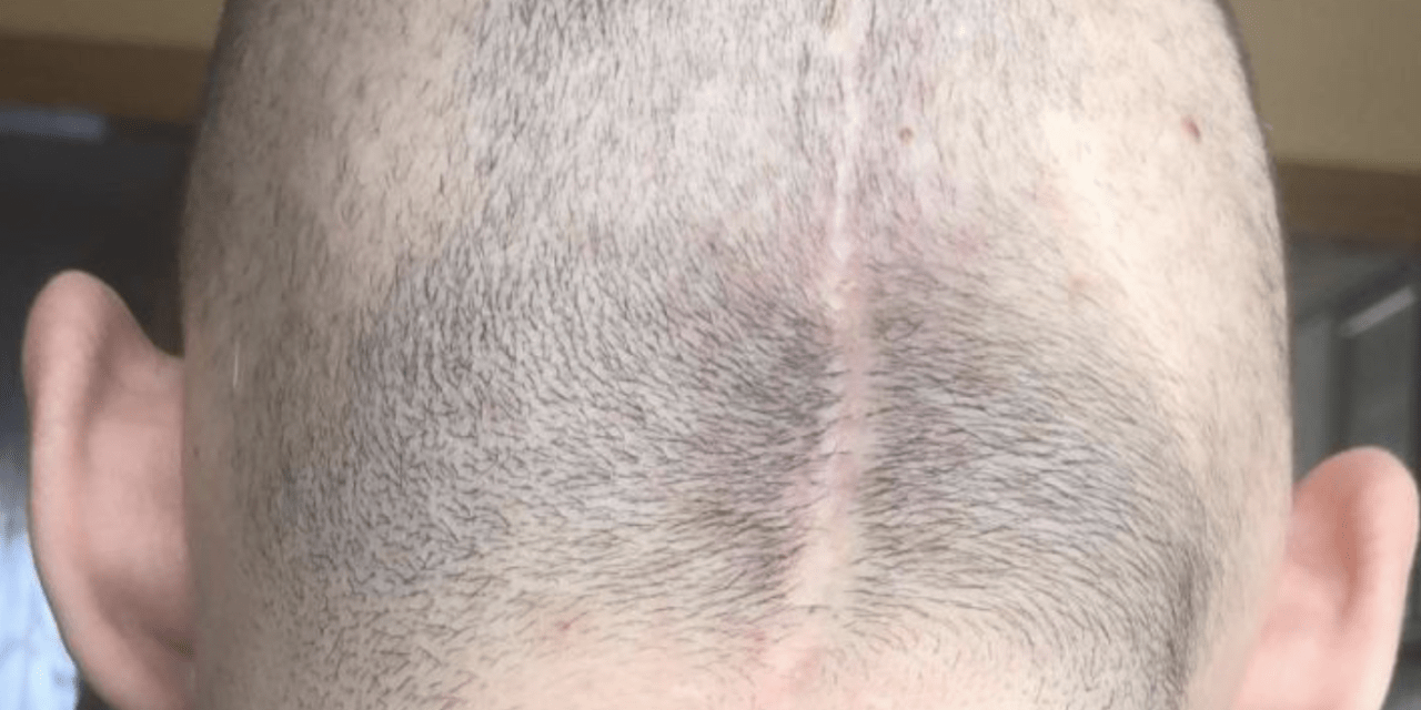 Un catalán que padece cáncer logra recaudar la cantidad necesaria para pagar su tratamiento capilar 