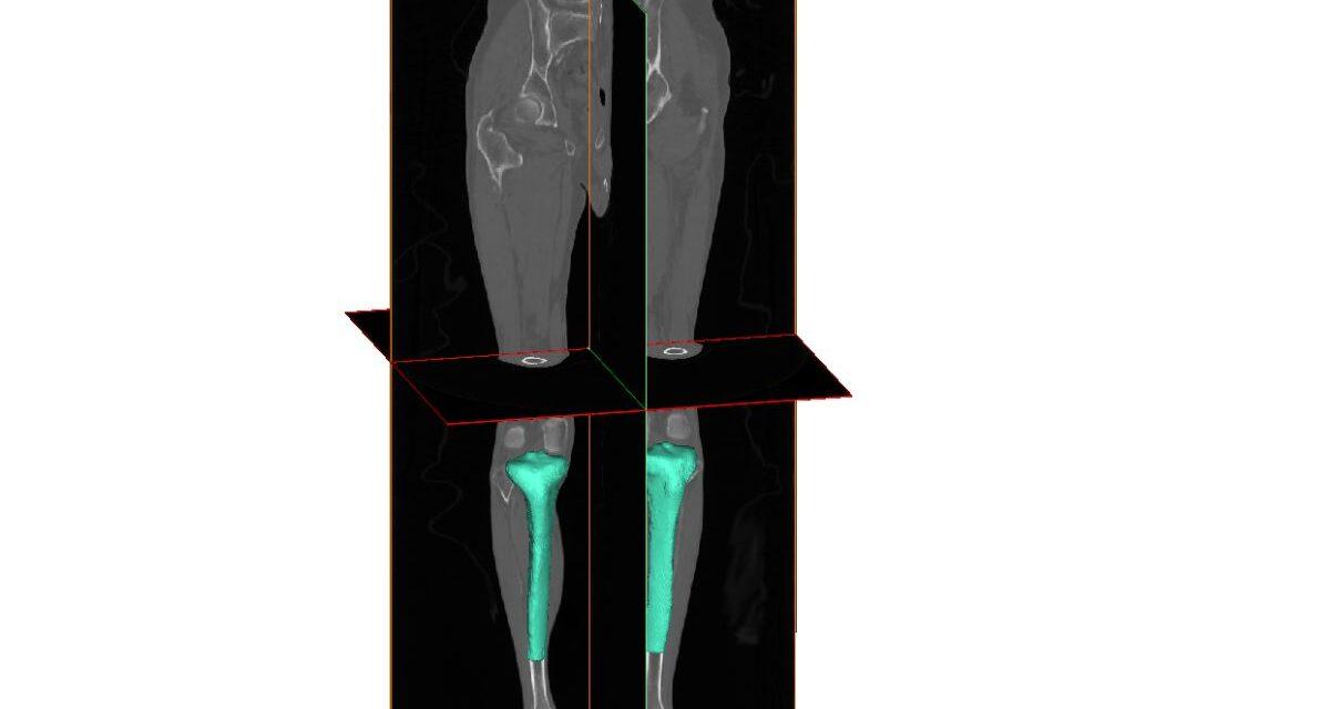 Investigan nuevos tratamientos para enfermedades osteoarticulares con Inteligencia Artificial y 3D