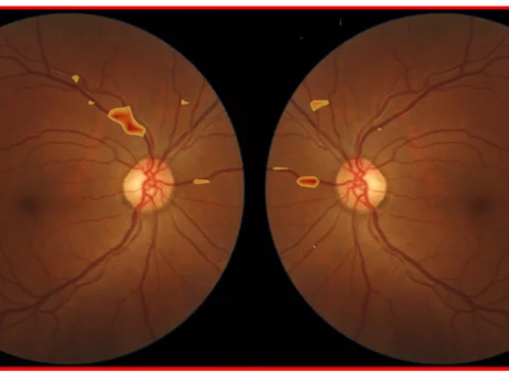 El proyecto 'Aitheroscope' analiza el fondo del ojo | Foto de la Fundación Mapfre