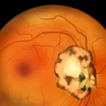 Descubren la erucamida: la molécula que ayuda al ojo a frenar la pérdida de visión